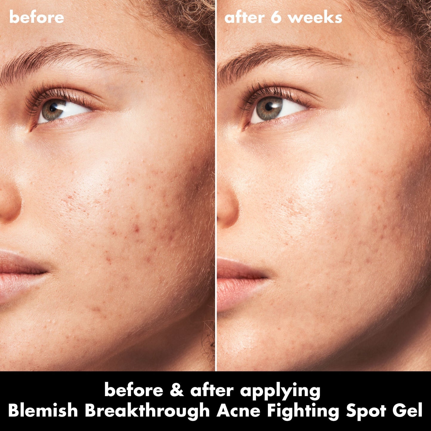 blemish-breakthrough-acne-fighting-spot-gel-o3 0326_EDU_BB_SpotGel_BA_MARLEY.jpg