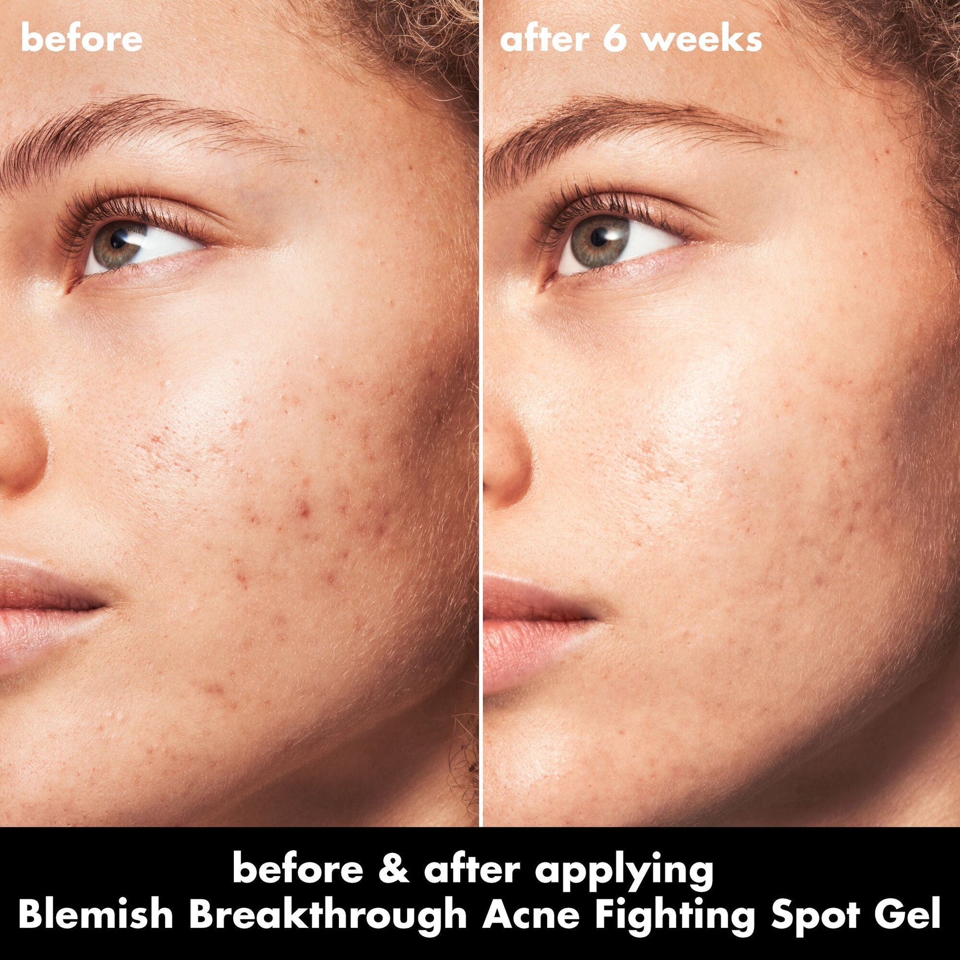 blemish-breakthrough-acne-fighting-spot-gel-o3 0326_EDU_BB_SpotGel_BA_MARLEY.jpg