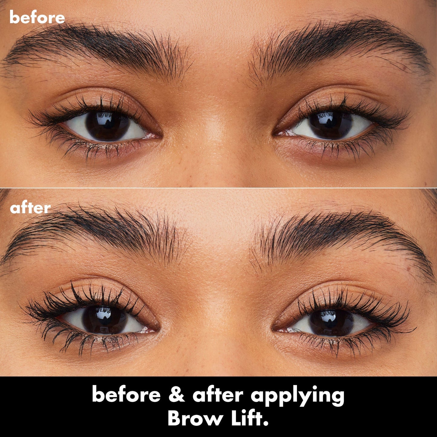 brow-lift-v8 0326_EDU_BrowLift_BA.jpg