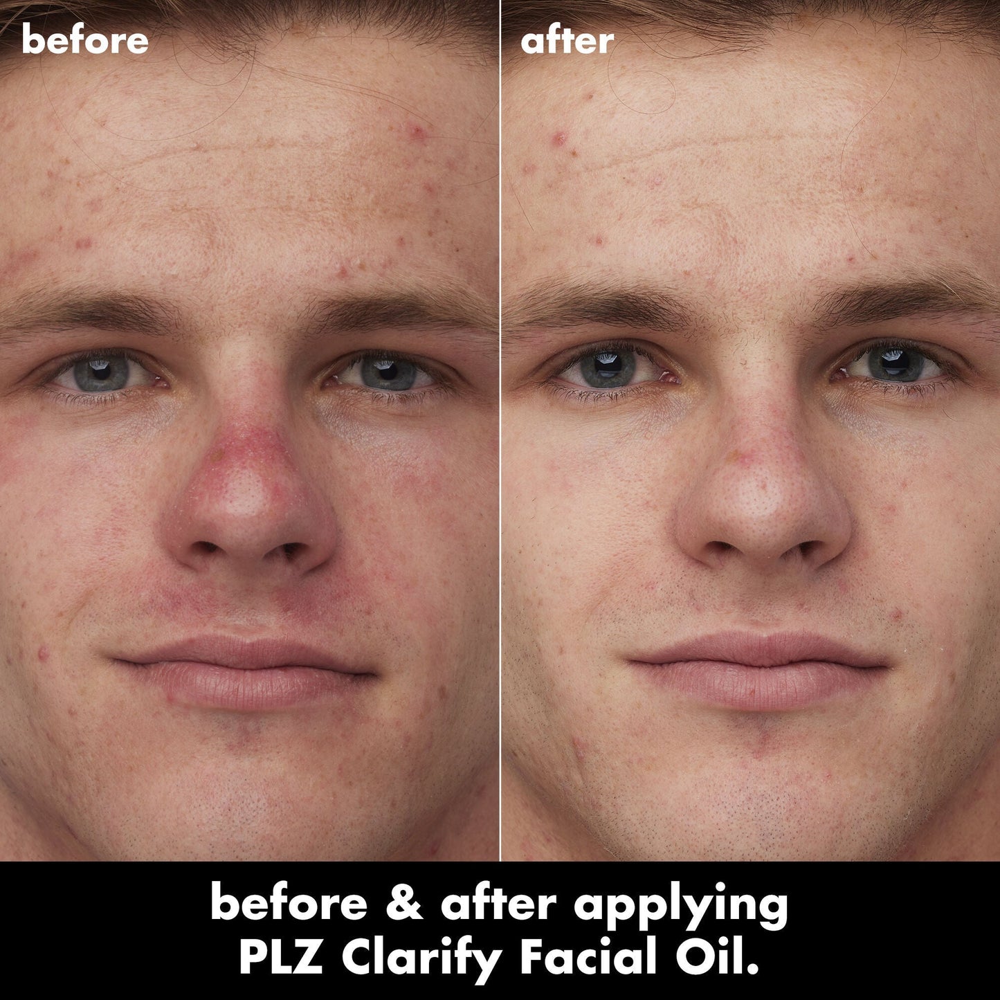 plz-clarify-facial-oil-z3 0326_EDU_PlzClarify_BA_Caleb.jpg