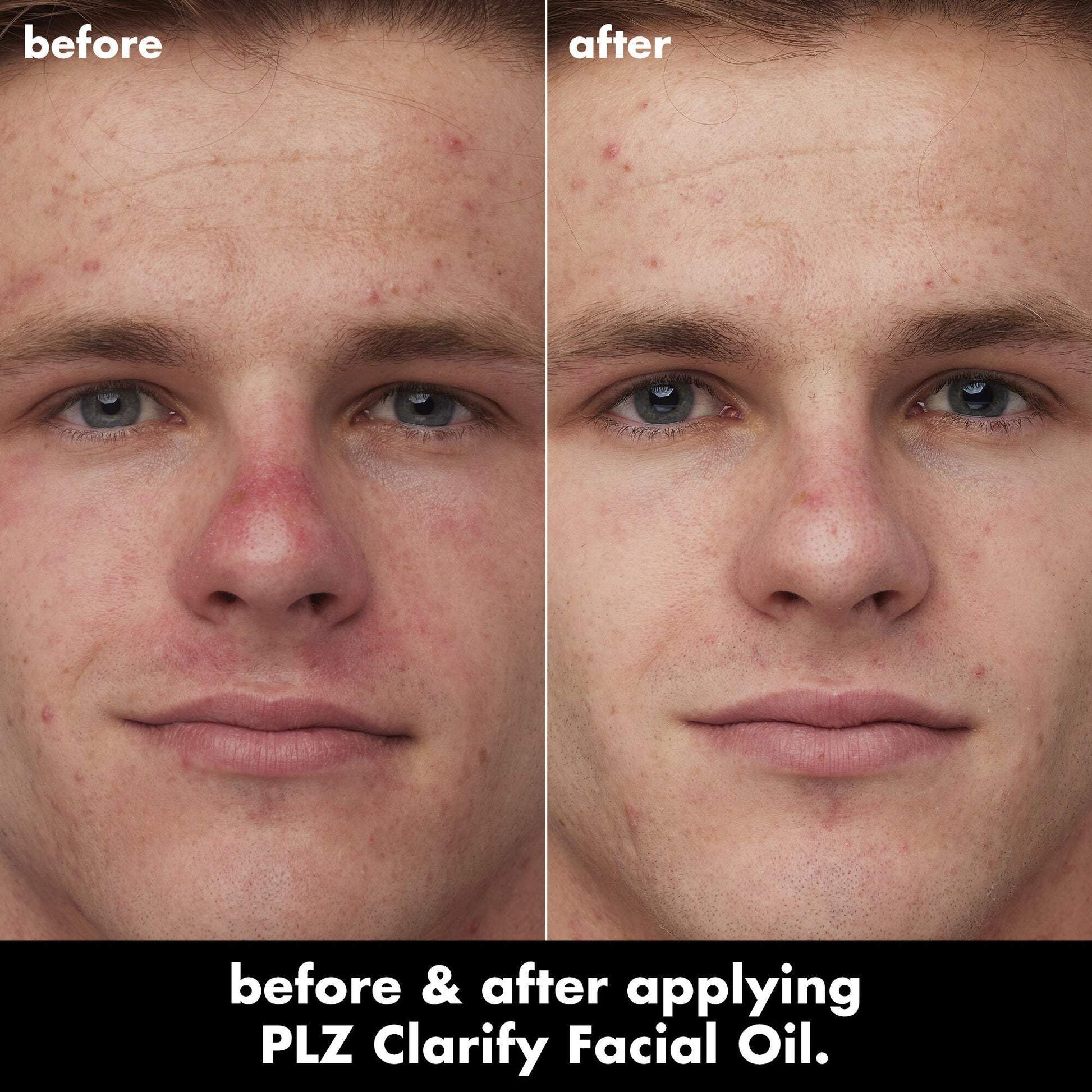 plz-clarify-facial-oil-z3 0326_EDU_PlzClarify_BA_Caleb.jpg