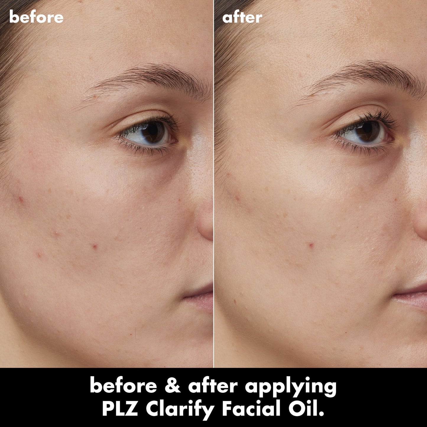 plz-clarify-facial-oil-z3 0326_EDU_PlzClarify_BA_Kelly.jpg