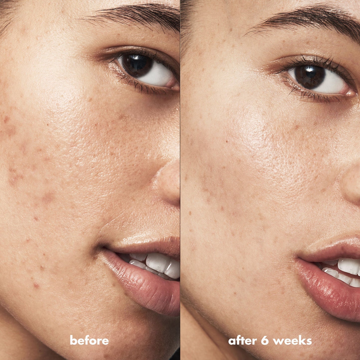blemish-breakthrough-blemish-control-basics-kit-z0 Acne_PDP_Isabella_Before_After_0fcb9356-ae60-4e94-8953-6b1b2219dc49.jpg