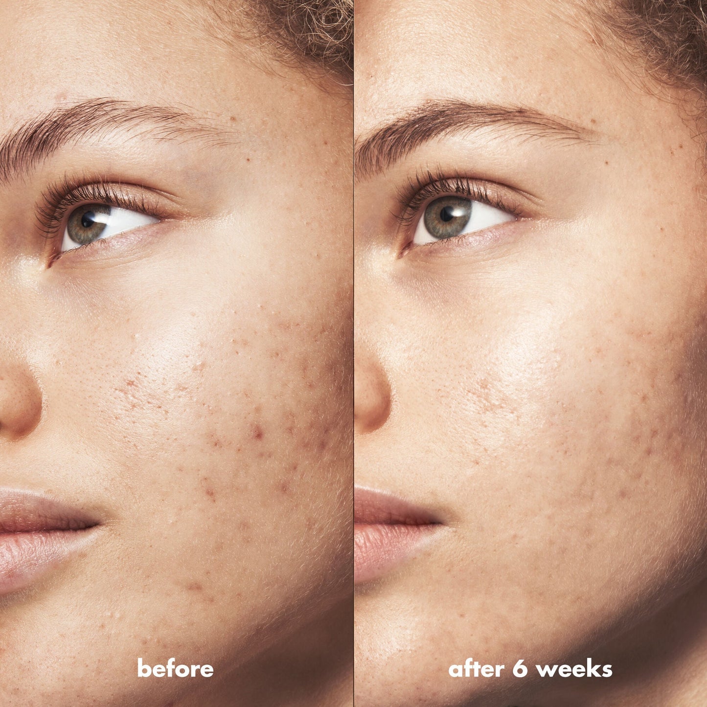blemish-breakthrough-acne-calming-water-cream-mini-y2 Acne_PDP_Marley_Before_After_acf01478-a58b-47ce-99b5-2ef1dc022f9b.jpg